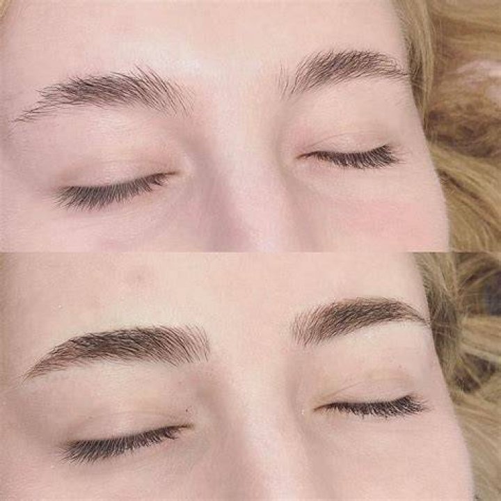 Eyebrow Hair Transplant: A Comprehensive Guide to Restoring Your Brows