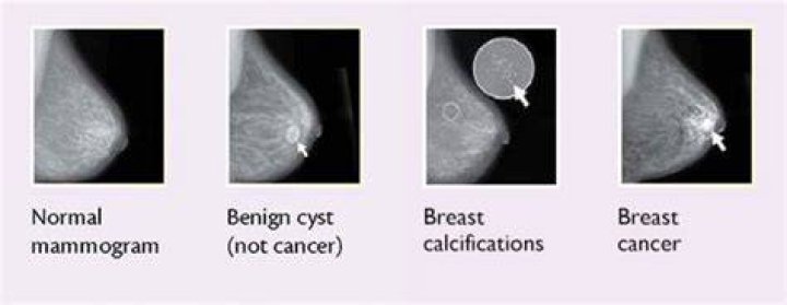 Hard breast cancer lump