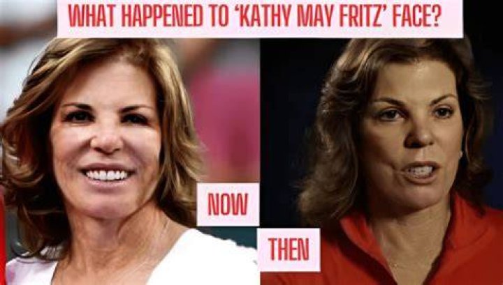 Kathy May Fritz: Unveiling the Truth Behind Her Face Surgery