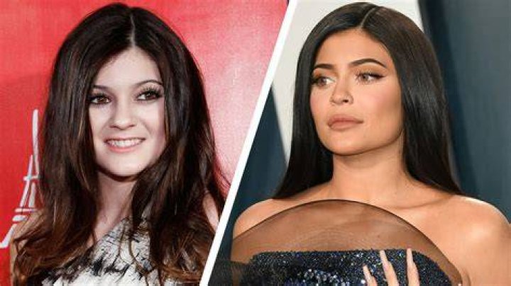 Kylie Jenner before and after