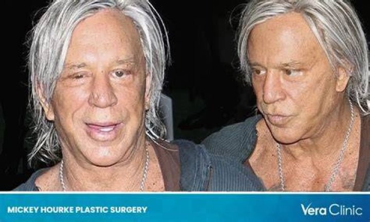 Mickey Rourke Plastic Surgery: A Deep Dive into His Transformation