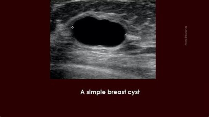 Soft breast cyst