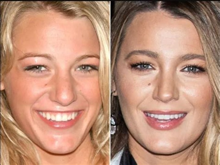 The Truth About Blake Lively's Nose: A Look at Her Transformation