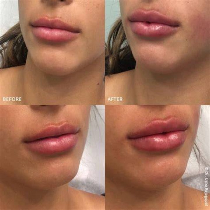 Understanding Bleach Fillers: A Comprehensive Guide