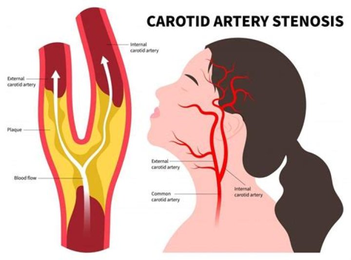 Understanding Carotid Artery Stenosis (TIA) and Kemo Surgery