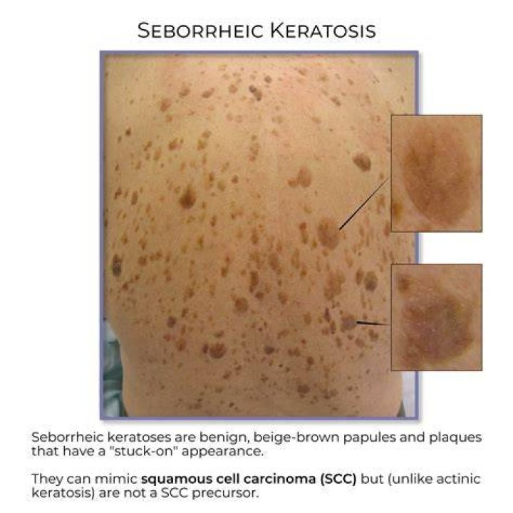 Understanding Kerato NYC: A Comprehensive Guide to Keratosis