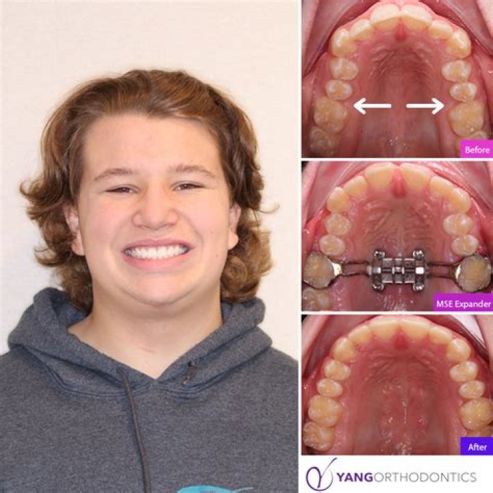 Unraveling Orthodontia Coverage: A Comprehensive Guide to Its Meaning