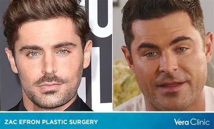 Zac Efron's Plastic Surgery Journey: Before and After
